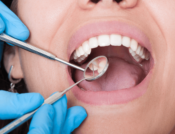 Tooth Discoloration Kya Hai